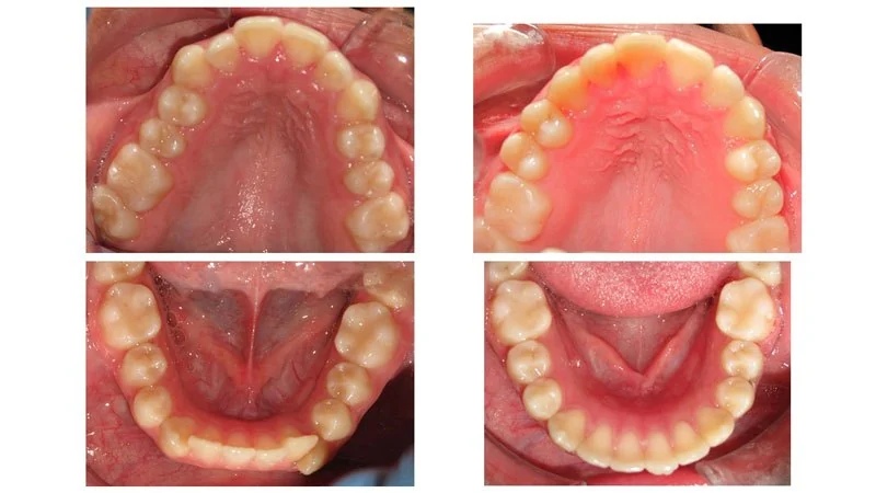 Before and After Smile Transformation 3