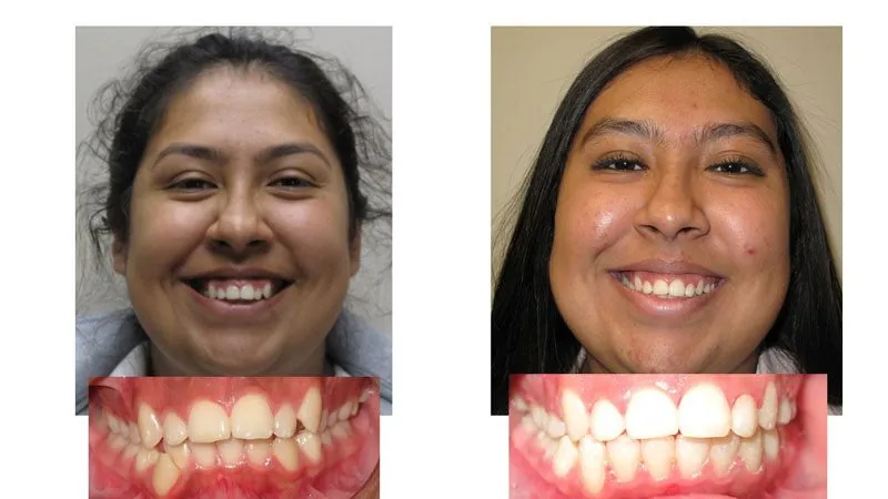 Before and After Smile Transformation 4