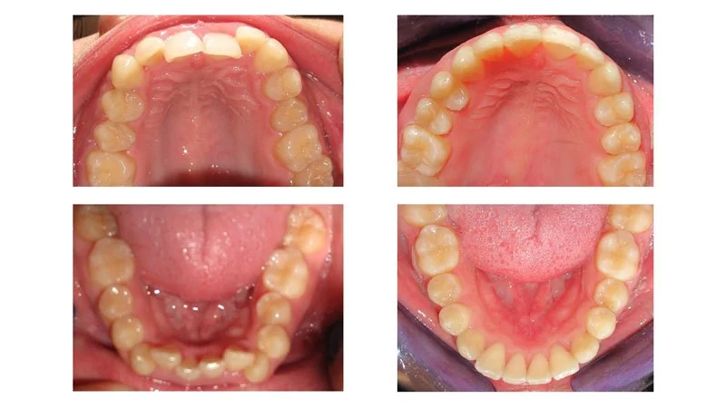 Before and After Smile Transformation 5