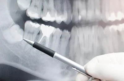 dentist pointing at an x-ray showing impacted wisdom teeth