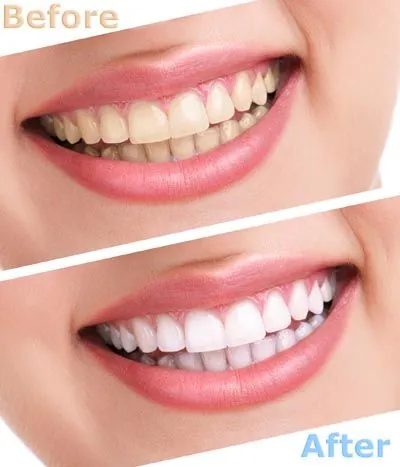 before and after photos showing how effective AZ Dental's teeth whitening treatment is